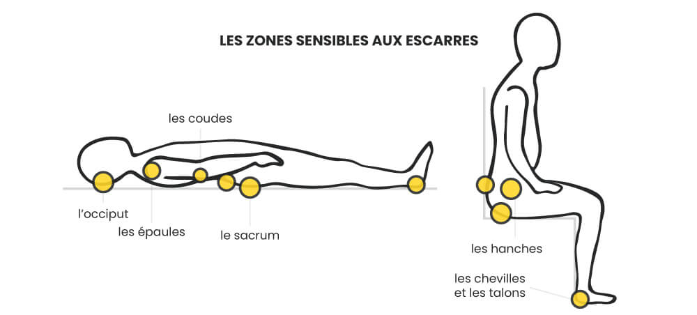 schema explicatif des zones sensibles au developpement des escarres sur personnes agees