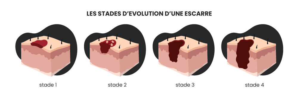 schema explicatif des differents stades d evolution des escarres